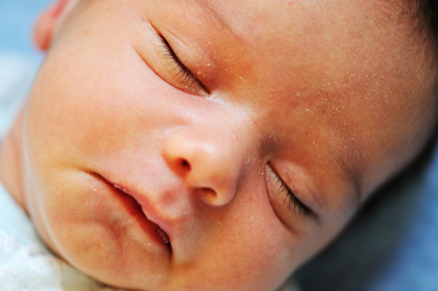 L’ittero neonatale. Che cos’è? L’ittero neonatale. Che cos’è?